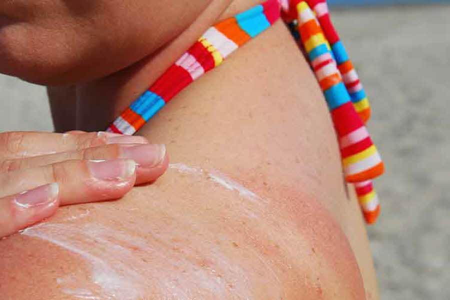 Når huden får for mye sol og ikke er tilstrekkelig beskyttet, kan den bli solbrent. Det kan være svært smertefullt og kan også gjøre at man føler seg uvel.